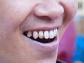 汚い歯
