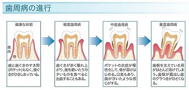 歯周病の進行