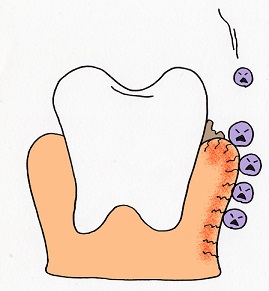 歯槽膿漏